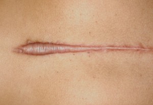 what-are-hypertrophic-scars1