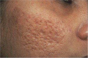 حفر حب الشباب acne scars